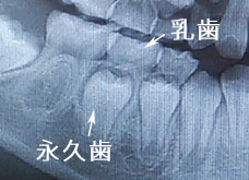 乳歯の下の永久歯