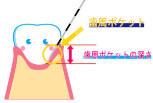 歯周ポケット