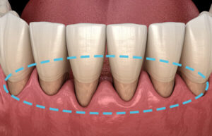 歯の根元が露出することによる虫歯