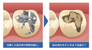虫歯の再発（二次カリエス）