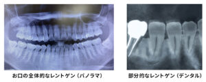 パノラマレントゲンとデンタル