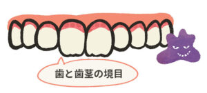歯の磨き残し-歯と歯茎の境目