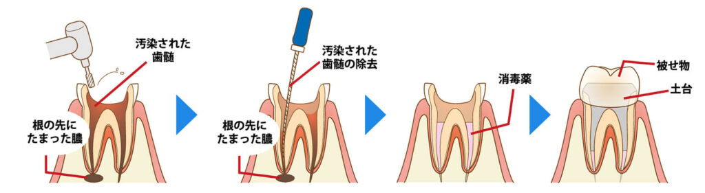虫歯の治療