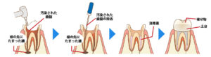 虫歯の治療