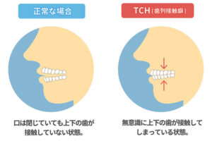 TCH（歯列接触癖）